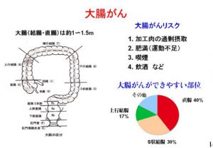 大腸がん